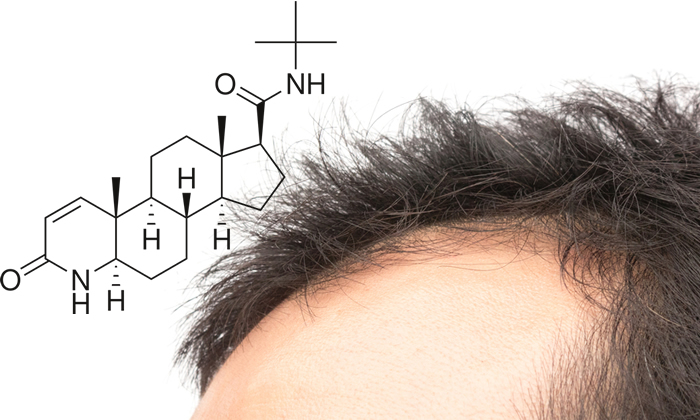 minoxidil e finasteride alopecia androgenetica maschile